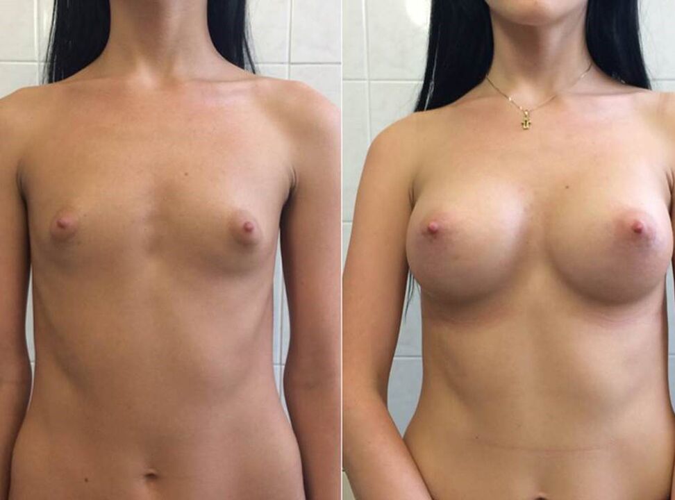 Fotos antes e depois de usar o creme Wow Bust de Anna de Berlim