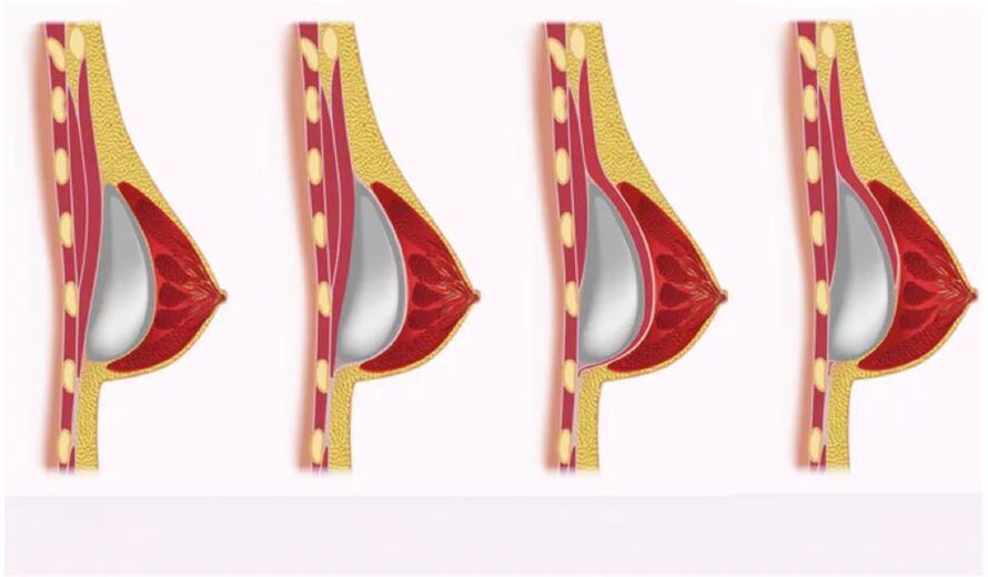 acesso para instalação de implantes